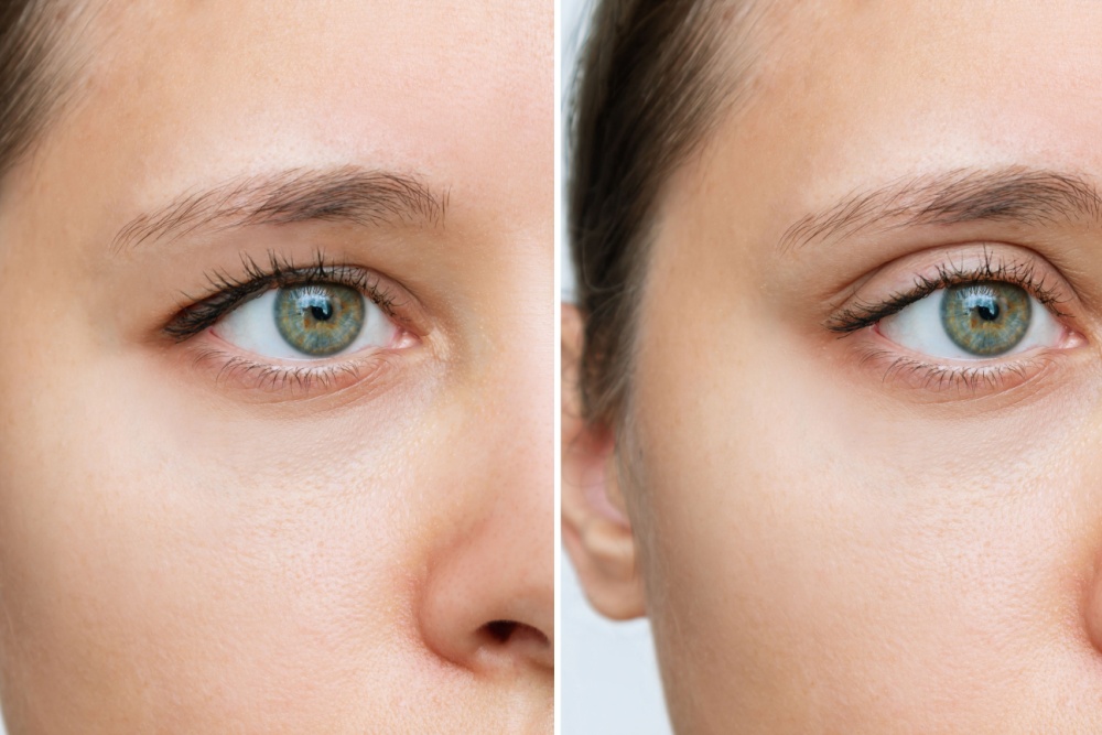 Blefaroplastia