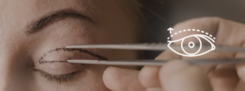 Blefaroplastia