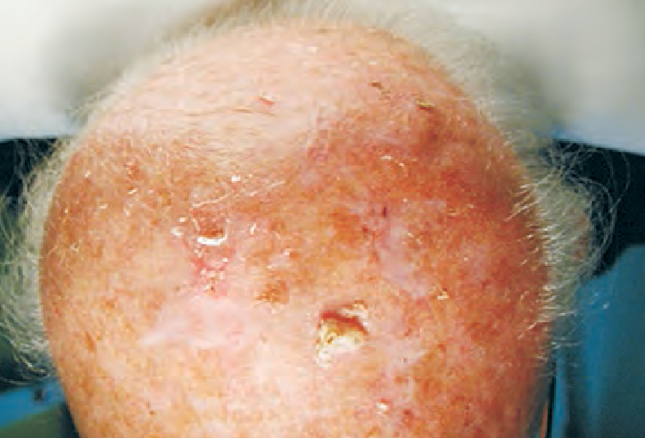 CERATOSE ACTINICA