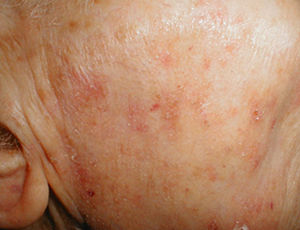 CERATOSE ACTINICA