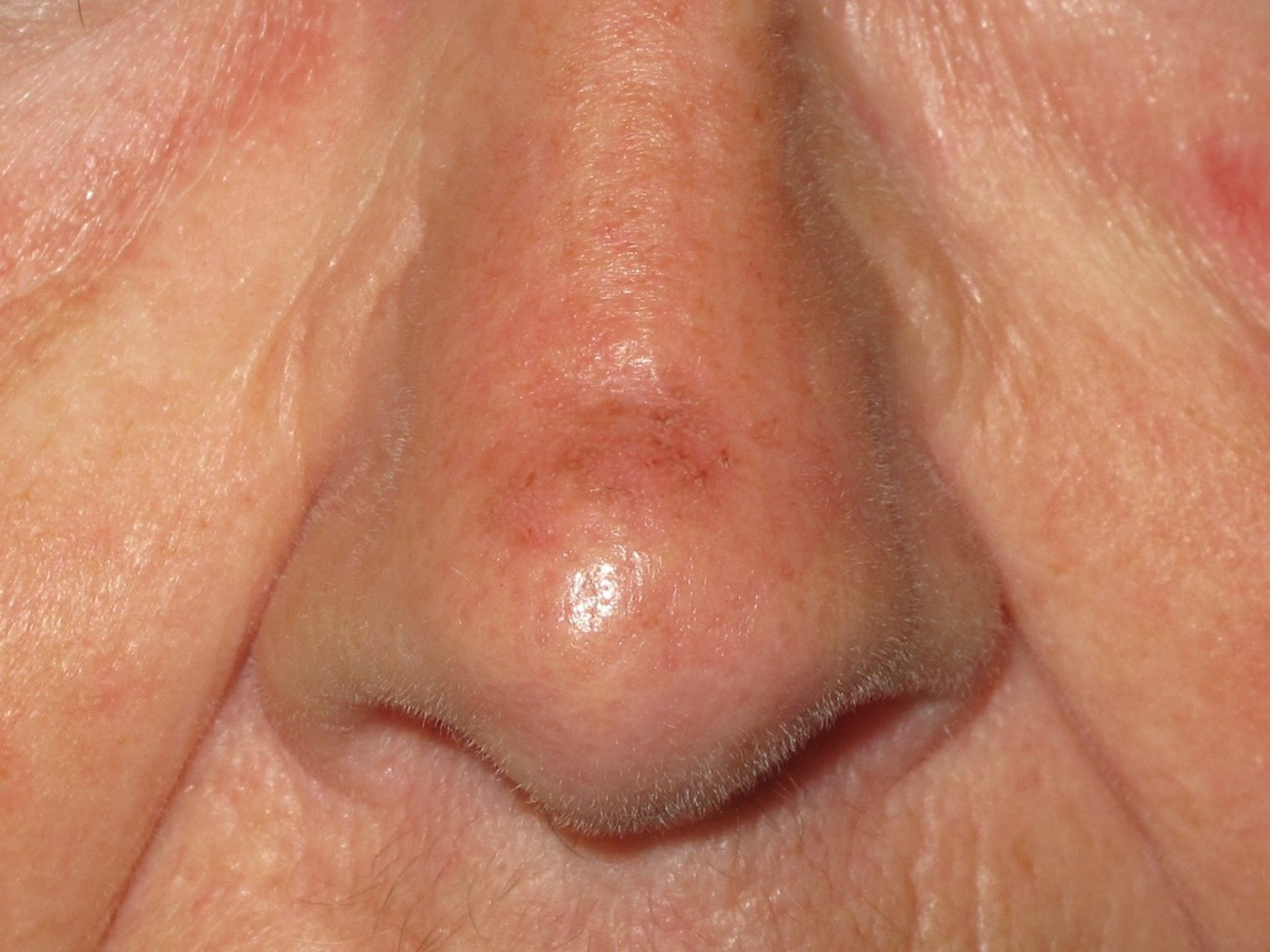 CERATOSE ACTINICA