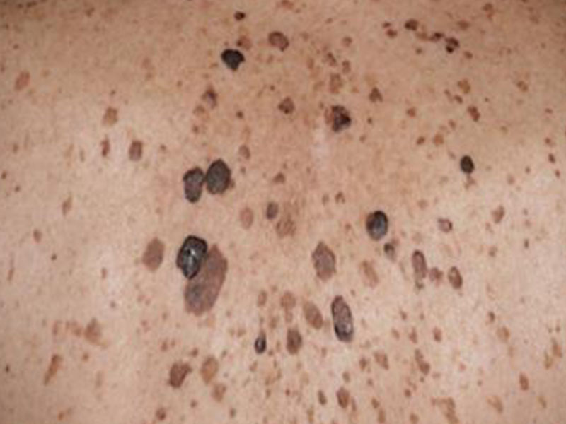 CERATOSE SEBORREICA