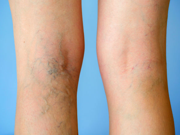 Escleroterapia