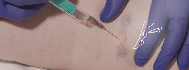 Escleroterapia
