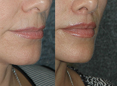 Lip-Lift