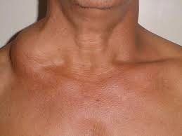 LIPOMA