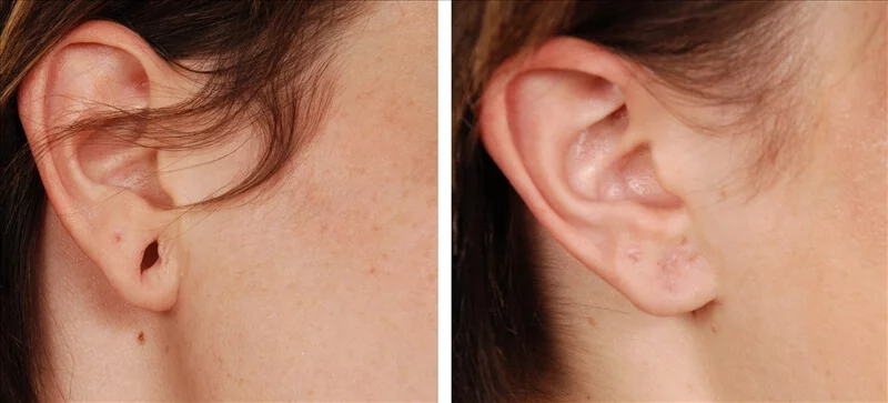Lobuloplastia